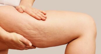 La rivoluzione per la cellulite: arriva la carbossiterapia e ti cambierà la vita