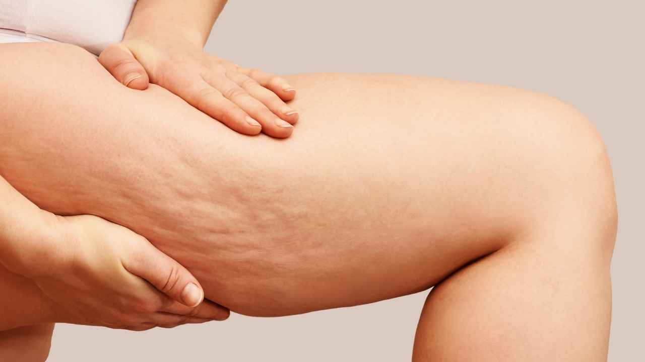 Cellulite