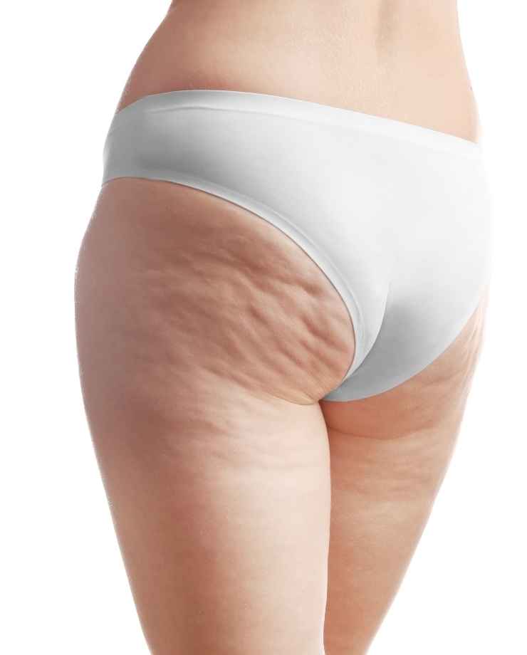 cellulite